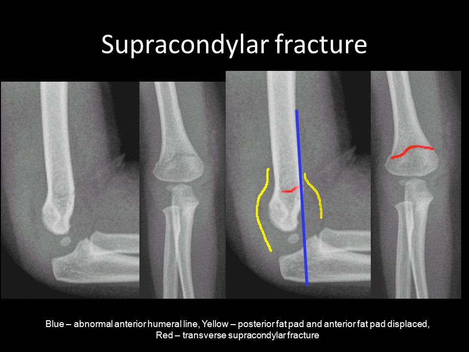 Non displaced supracondylar fractures treatments for diabetes Non displaced supracondylar fractures treatments for diabetes op amp gain equation investing 101
